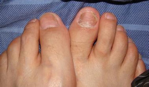 冬季脚气患者穿鞋有讲究