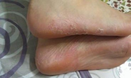 不同类型的脚气又症状有什么体现呢