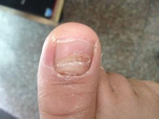 专家为您讲述脚气的护理原则