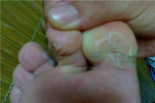 水泡型脚气的护理该怎么做