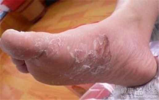 生活中怎样的预防脚气