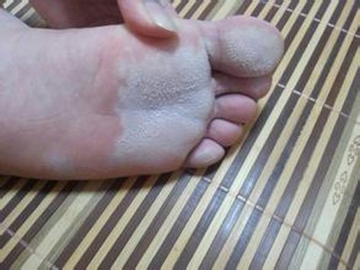 生活中怎么免受脚气的困扰