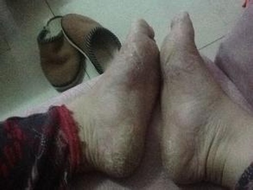 生活中是哪些原因引起脚气病发的呢