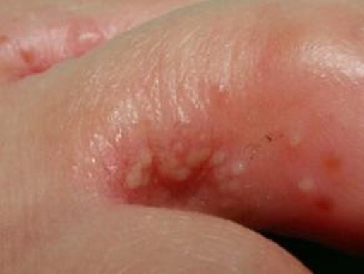 你知道汗疱疹与脚气差异是什么吗