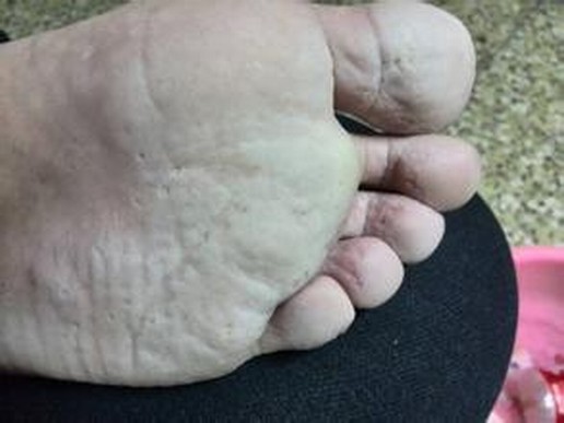脚气症状有什么呢