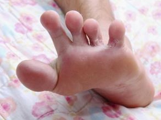 脚气长期不治疗很可能会引发灰指甲