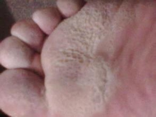 脚气怎样预防最有效