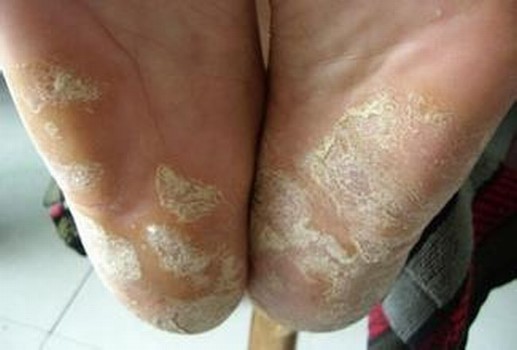 脚气有哪些常见症状