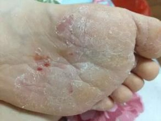 脚气是如何进行传染的