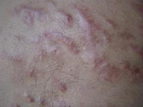 皮肤疥疮疾病要如何护理