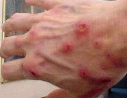 疥疮患者个人千万注意
