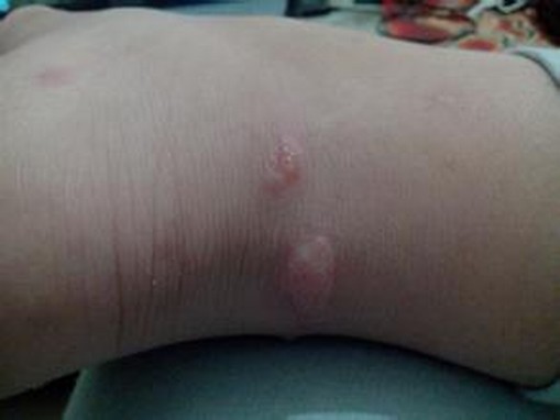 婴幼儿疥疮的症状有哪些