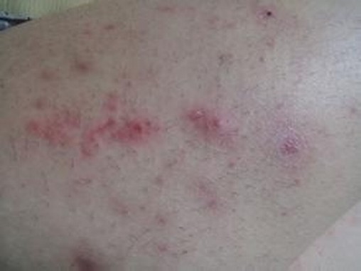 疥疮也许引起严重的皮肤损害