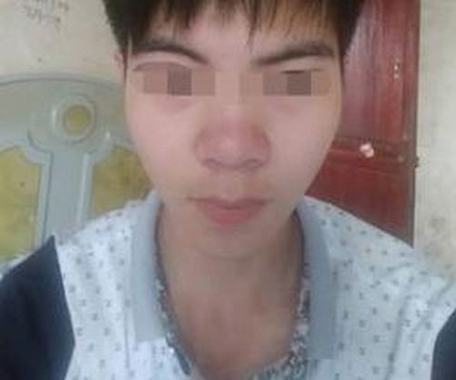 酒糟鼻护理方法有哪些