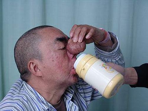 酒糟鼻该如何预防