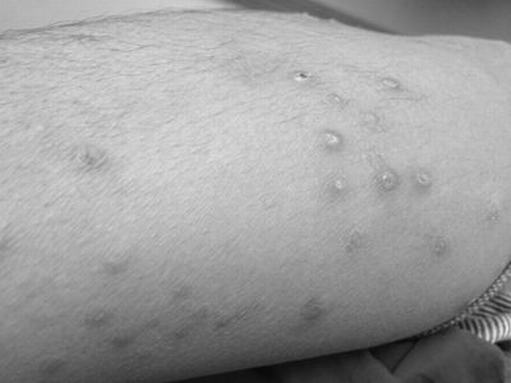 皲裂性湿疹的症状表现有哪些呢