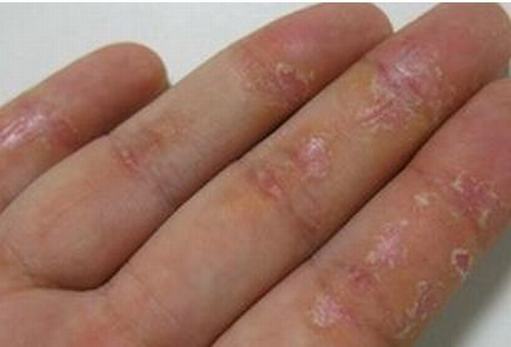 皲裂性湿疹初期的症状都有哪些