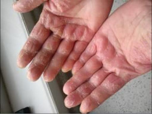 手部皲裂性湿疹在治疗时应该注意什么