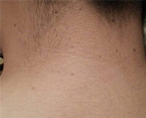 黑棘皮病的各种类型都是如何区分的