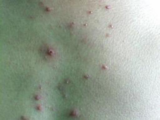 急性荨麻疹的症状有哪些