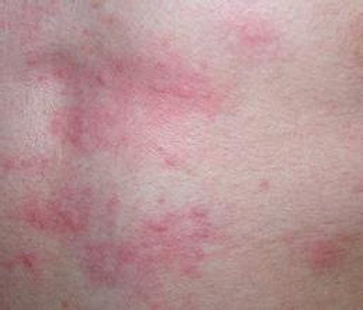 急性荨麻疹的症状详解