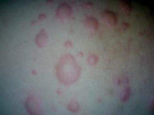 急性荨麻疹的症状表现
