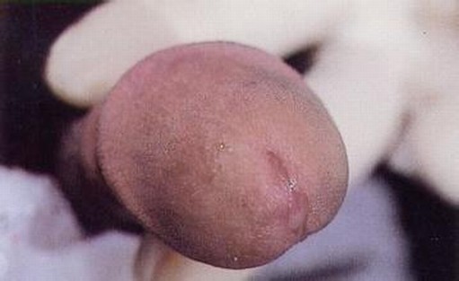 淋病生活中注意什么