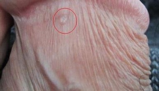 女性淋病症状有哪些啊