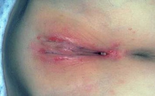 女性怎么有效的预防淋病