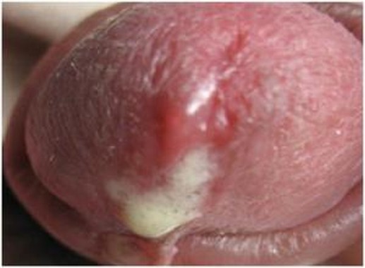 了解女性淋病的常见症状