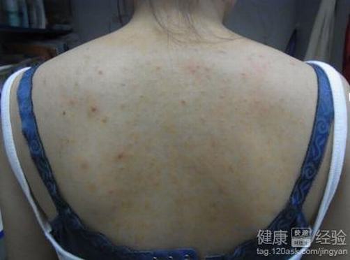 患了毛囊炎生活护理怎么做