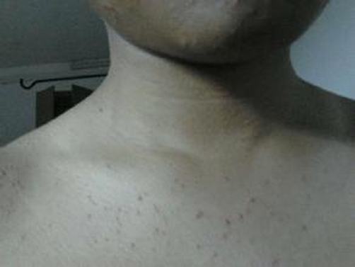男性阴毛囊炎症状是怎样的