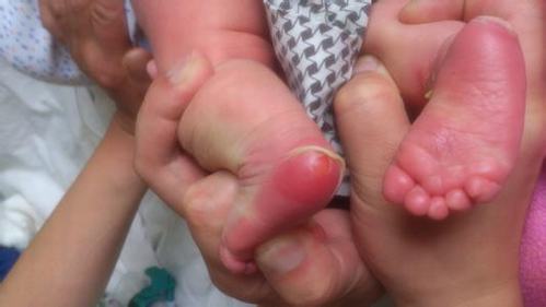 掌趾脓疱疮的病因和治疗