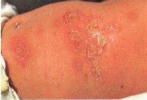 预防新生儿脓疱疮的方法