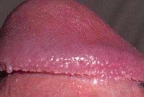 哪些是男性尖锐湿疣的表现呢