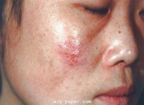 新生儿单纯疱疹症状的表现