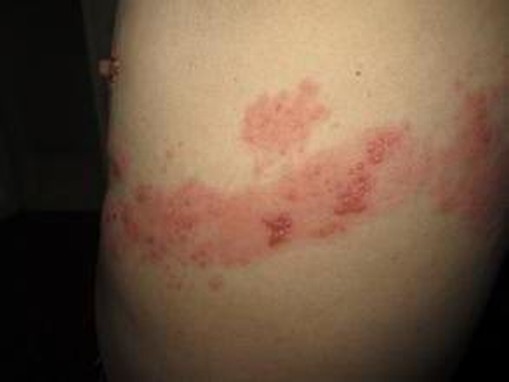 疱疹患者的复发症状介绍