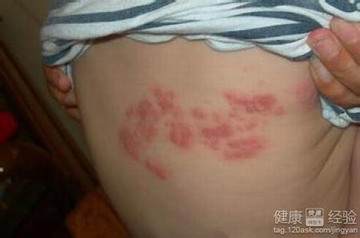 得了疱疹的人有什么表现