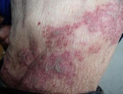 单纯性疱疹病毒引发的症状表现