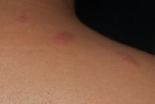单纯疱疹主要有何症状