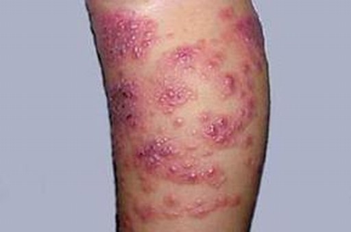 单纯疱疹症状具有的危害性分析