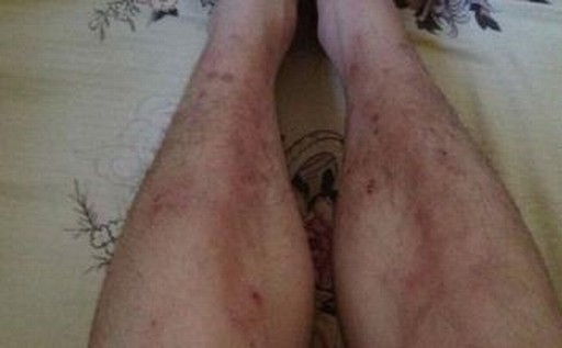 单纯疱疹症状的主要表现特点