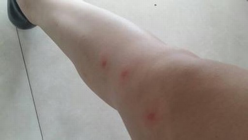 单纯疱疹应该怎样的预防