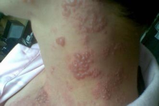 单纯疱疹患者的病情介绍