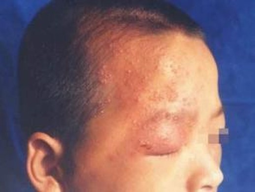 单纯疱疹发生情况的基本介绍