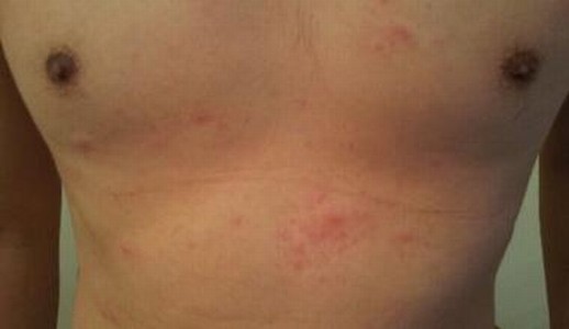 单纯疱疹患者的基本临床症状