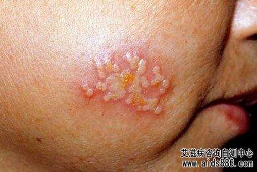 小儿病毒性疱疹的表现是如何的呢