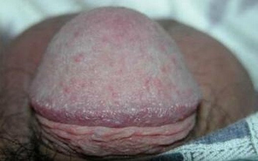 妊娠疱疹出现的重要特点介绍