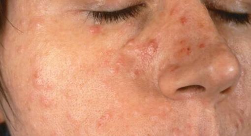 预防皮肤白血病常见的方法