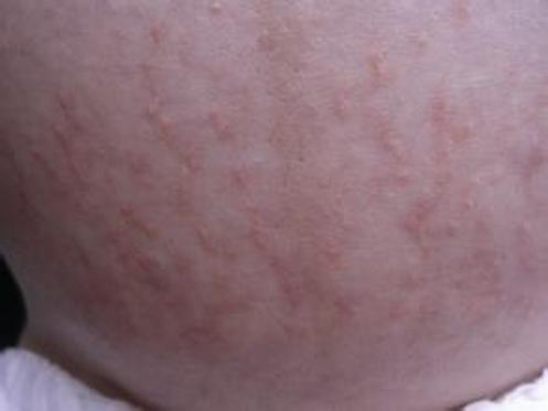 皮肤瘙痒对患者造成的影响